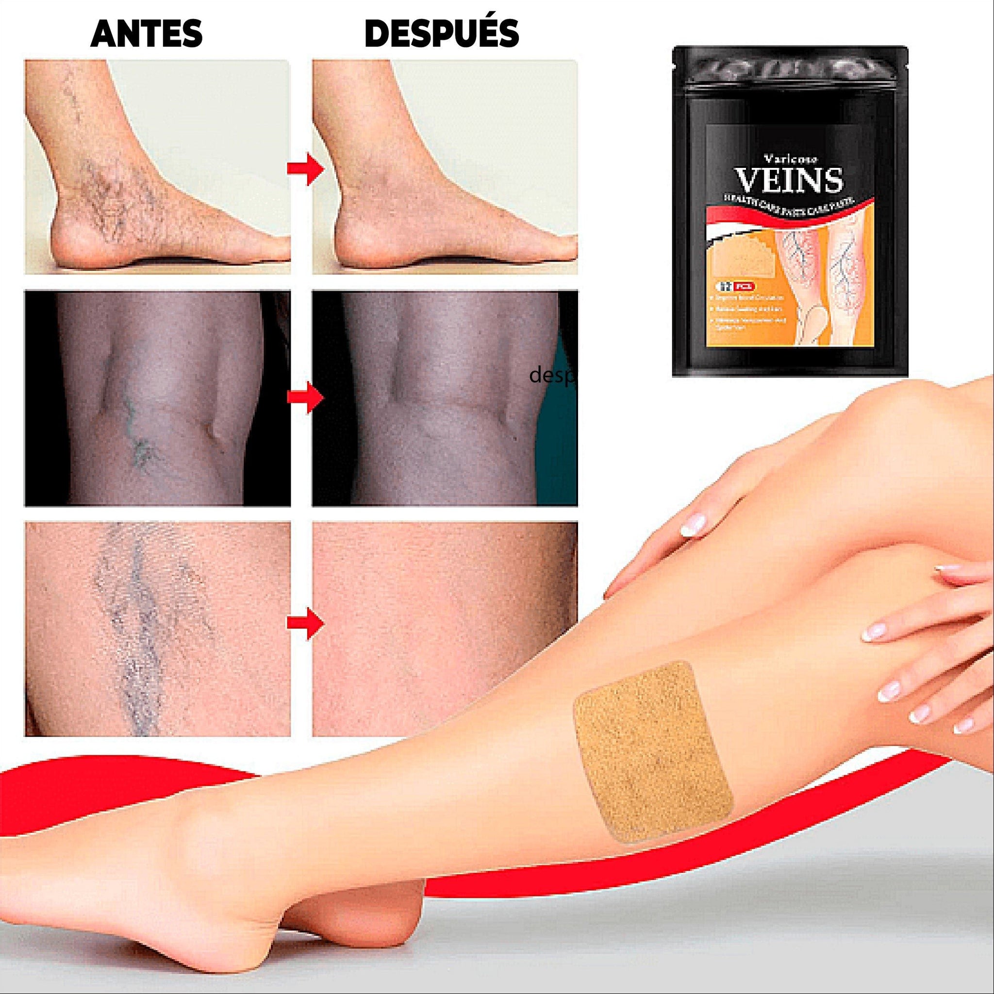 PARCHES NATURALES PARA ELIMINAR VARICES - SANAVITA™