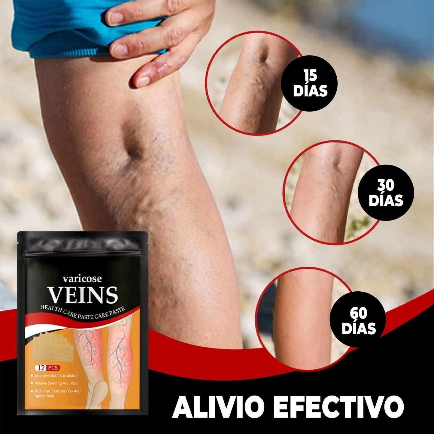 PARCHES NATURALES PARA ELIMINAR VARICES - SANAVITA™